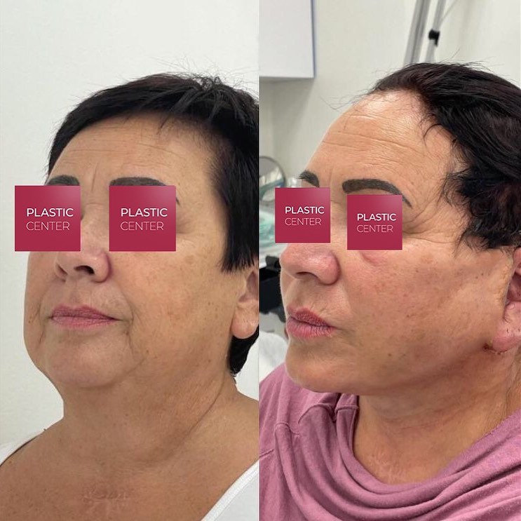 Facelifting Plastic Center